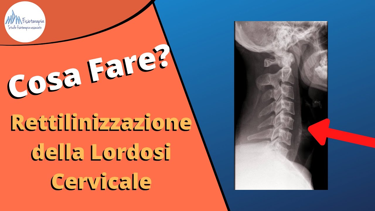 rettilinizzazione-della-lordosi-cervicale-youtube