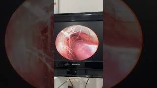 #kulak #kulakburunboğaz #kulakkiri