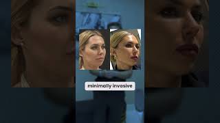 Different Types of Facelifts by a Triple Board Certified Plastic Surgeon