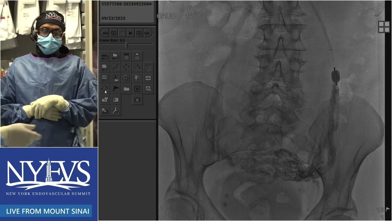 Live Case: Pelvic Congestion Syndrome Treatment