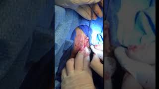Vaginaplasty