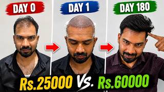 Hair Transplant Cost : ₹10 vs. ₹30 Per Grafts Exposed 🔥🔥🔥 Hair Transplant Cost In India