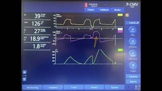 Double Triggering in Pressure Control Mode of Ventilation