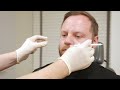 Male eye bags  treatment with dermal filler