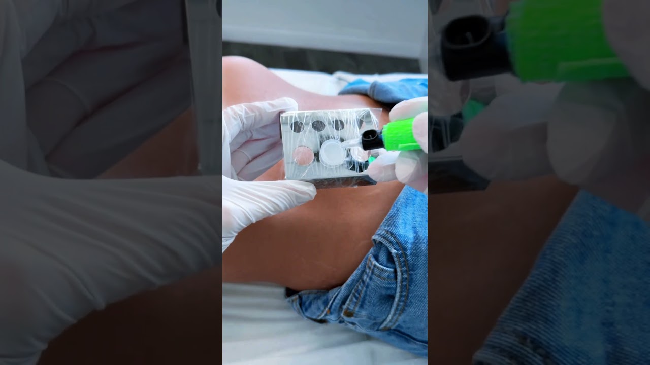 stretch marks remover