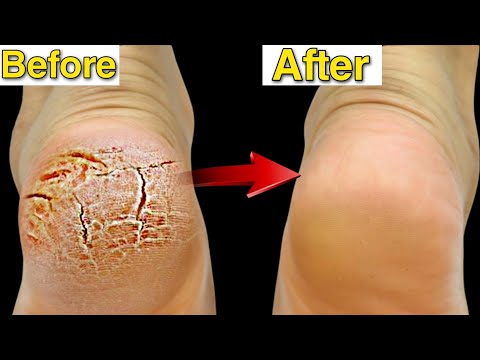 Permanently Remove Cracked Heels and Get Beautiful Feet  - Magical Cracked Heels Home Remedy