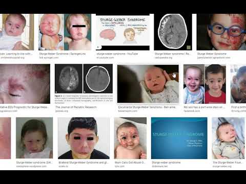 STURGE WEBER SYNDROME СТУРЖ ВЕБЕР СИНДРОМ КЛИНИЧЕСКОЕ ПРОЯВЛЕНИЕ И ОСОБЕННОСТ TUS STS USMLE