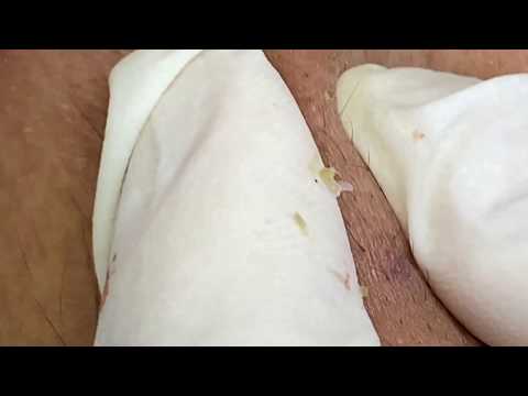 Video Acne, oily fibers for boyfriends thuytruong#33 - youtube