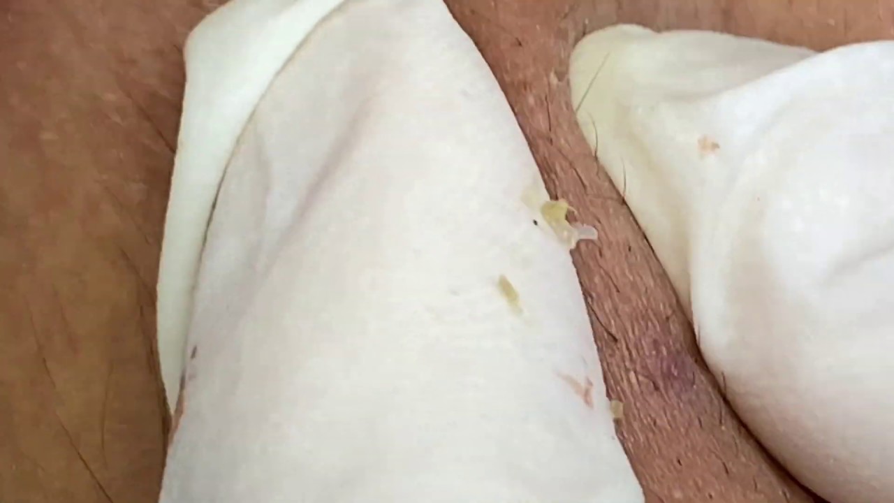 Acne, oily fibers for boyfriends thuytruong#33