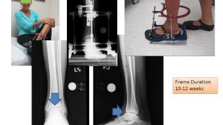 Ankle Distraction Surgery