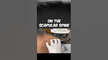 Find the suprascapular nerve location every time! #shoulder #nerveblock #suprascapular