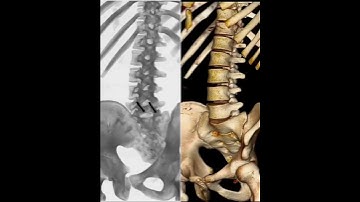 Không nên vội mổ ngay khi bị đau lưng, trừ khi có dấu hiệu nguy cấp.