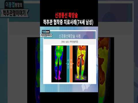 이동엽원장의 신경풍선확장술로 척추관 협착증 치료사례(76세 남성)