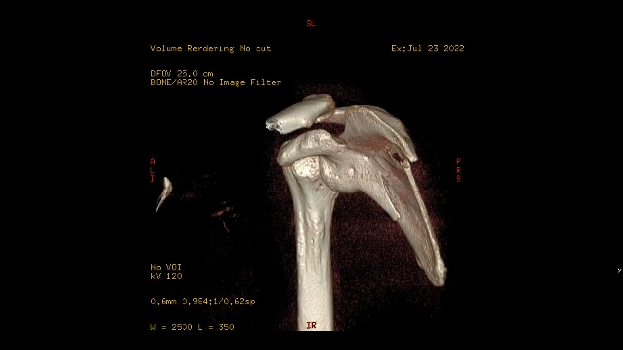 Scapula CT after MTB Crash YouTube