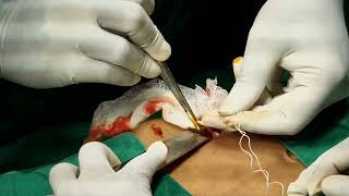 Open Appendectomy | Live surgical video