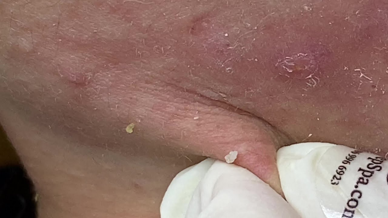 Pimples Around The Neck and Cheeks P2 | Mụn Quanh Cổ Và Má P2 - SacDepSpa#140