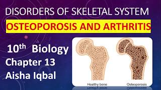 Disorder Of Skeletal System Class 10