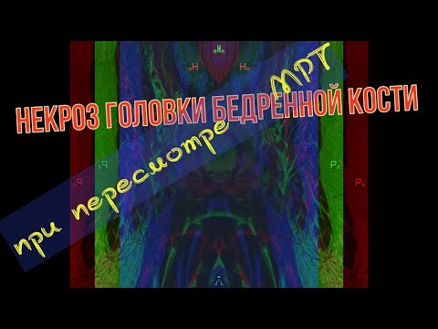 Асептический НЕКРОЗ ГОЛОВКИ БЕДРЕННОЙ КОСТИ на РАСШИФРОВКЕ МРТ тазобедренного сустава видео