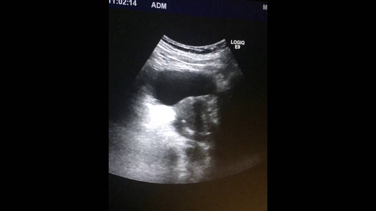 Дивертикул мочевого пузыря. Псевдодивертикулез мочевого пузыря . ДГПЖ ...