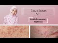 Acne Scars Part 1 - Post Inflammatory Erythema