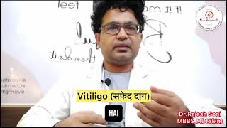 #vitíligo #vitiligotreatment #udaipur #dermatologist