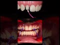 peg lateral #dentist#dentist #smile