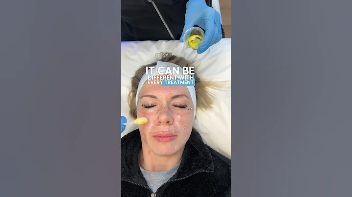 ZO 3 step peel for fine lines, wrinkles, acne scars, pigmentation. Safe for all skin types.