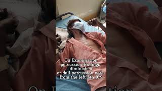 Clinical Case 2-Pleural effusion#mbbs #medicine