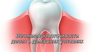 Лечение кровоточивости десен в домашних условиях(, 2014-04-27T12:54:57.000Z)