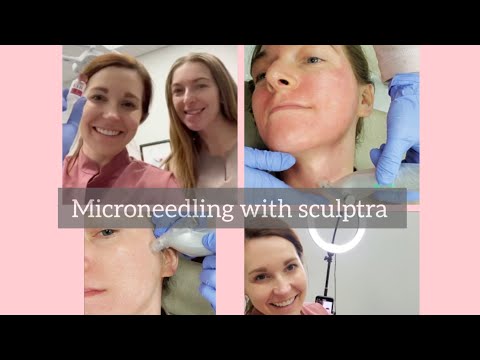 Microneedling with Sculptra Vlog, before, during, and after treatment