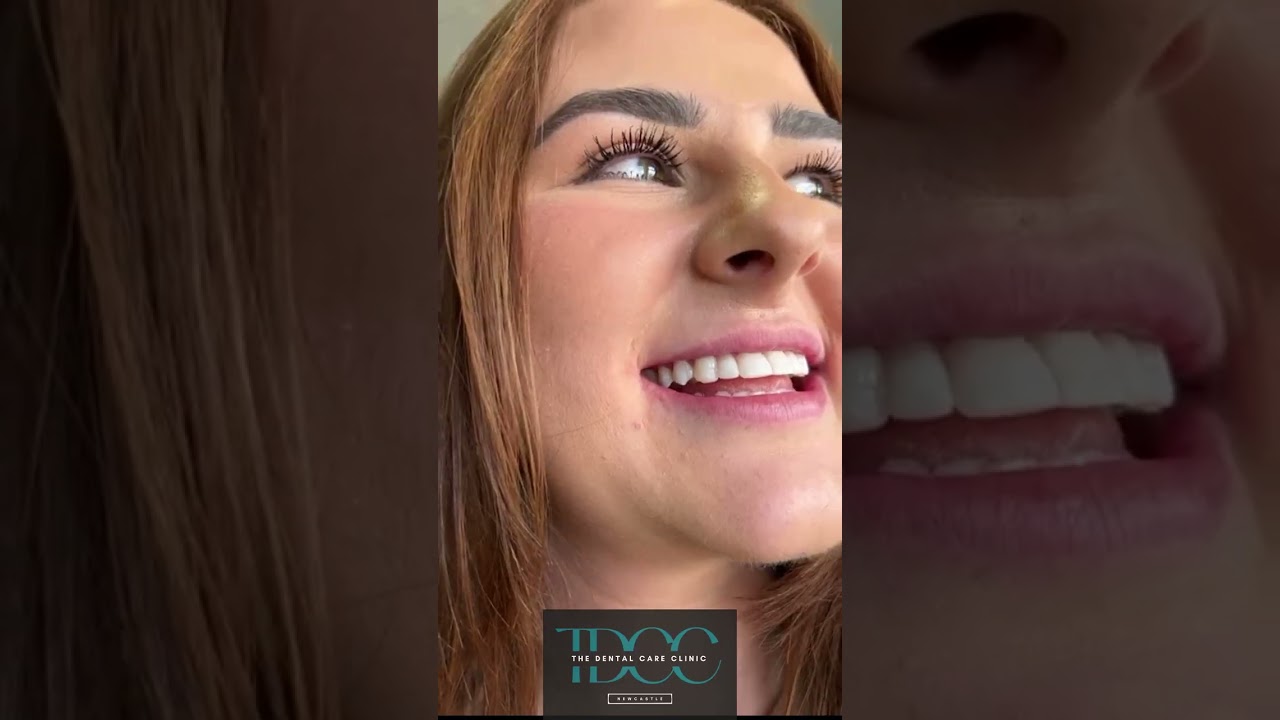Benefits of Composite Bonding for a Perfect Smile! 🦷✨ | Tooth Talk Tuesday
