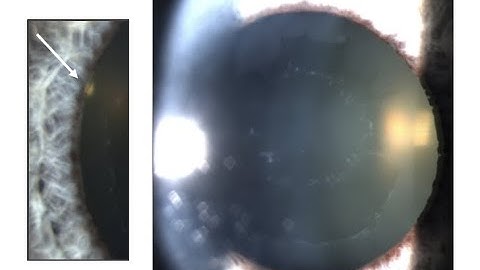 1 Slide in 5 Minutes: Pseudoexfoliation (Malik Y. Kahook, MD)