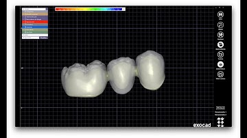 Exocad 10 minutes guide - Reduced three element bridge - Ponte di tre elementi ridotto