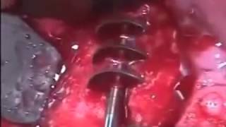 Процедура установки базальных имплантов(Базальная имплантация зубов -- это устаревший и очень травматичный метод восстановления зубов. На сегодняш..., 2014-03-07T08:53:12.000Z)