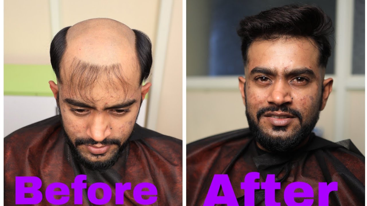 Hair Fixing and Hair Replacement Centre in Bangalore | Customized Hair patch video Cal 9110221804