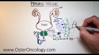 Prostate Cancer - An Illustrative Walk-Thru (A TUTORIAL from Oster Oncology)