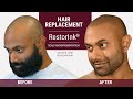 Restore Hairline with Scalp Micropigmentation | RestorInk®