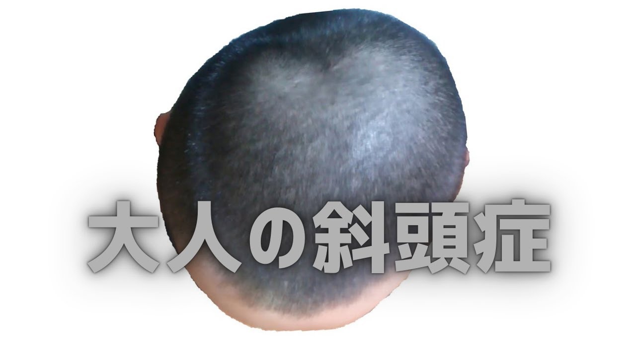 医者や社会が理解していない斜頭症による身体への影響 【頭の形の盲点】 - YouTube