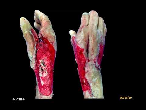 Vídeo: Degloving: Imágenes, Tipos, Tratamiento Y Complicaciones