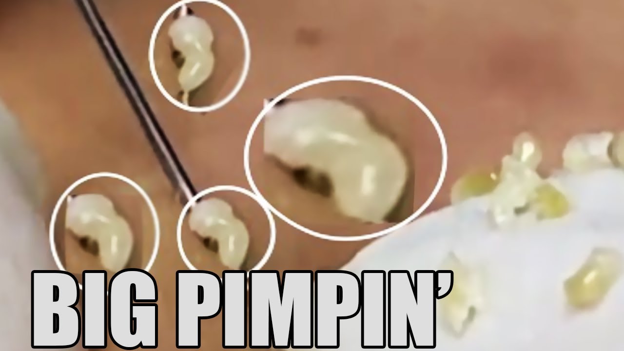 Pimple Popping And Blackheads And Whiteheads Youtube