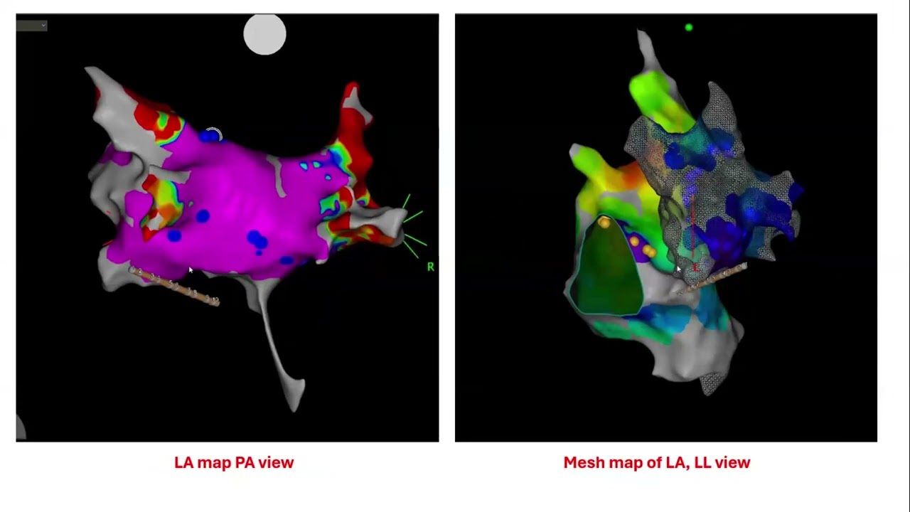 Cardio neuro ablation case Presentation Hamed Gaber, MBChB