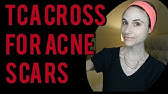 How To Treat Ice Pick Scars 