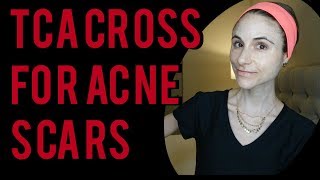 TCA CROSS FOR BOXCAR AND ICE PICK ACNE SCARS| Dr Dray