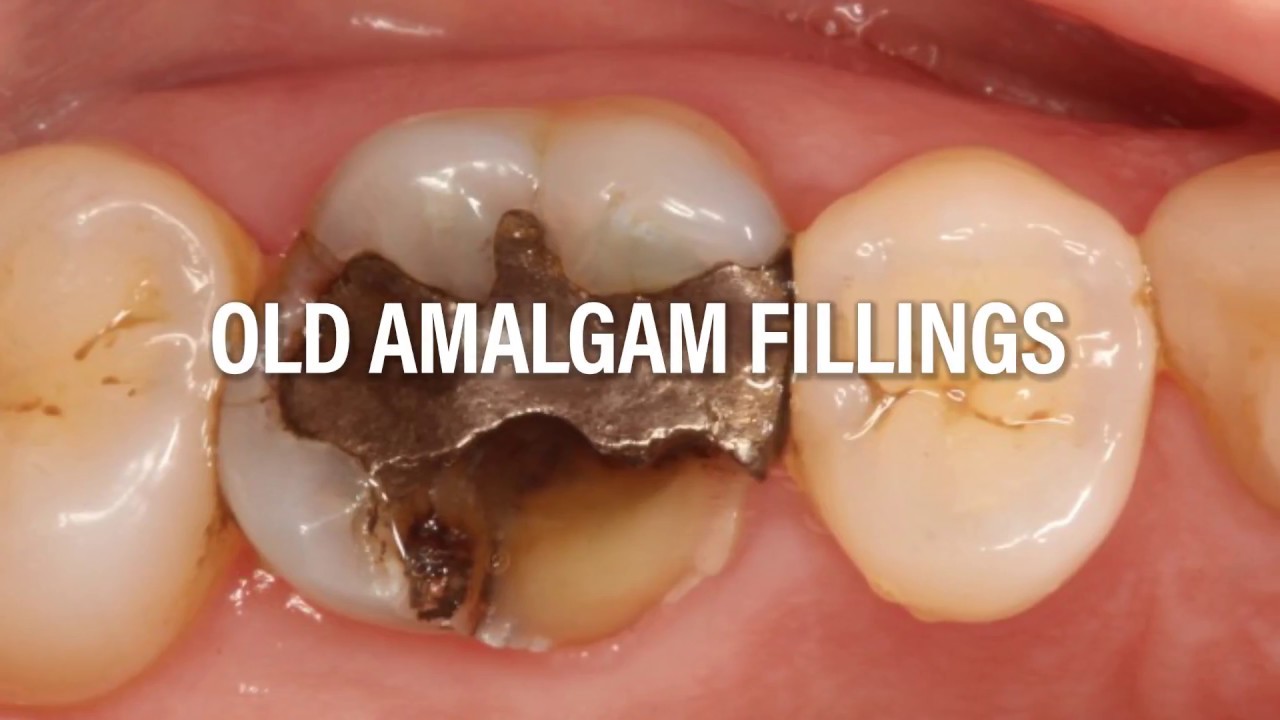 Replace your old amalgams with porcelain restorations with Dr. Samadian