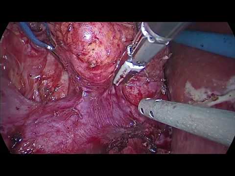 TUMORECTOMIA SUPRARRENAL- FLUORESCENCIA-SOCIEDAD VASCA UROLOGIA