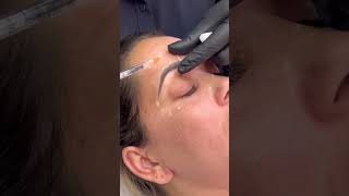 Botox - Aplicação Rápida E Tranquila