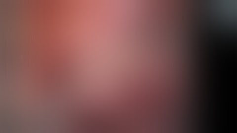 Benjamin I  Chung - Complex Robotic Partial Nephrectomy in a solitary kidney