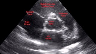 Parasternal Short Axis View Aortic Level - Loop Guide