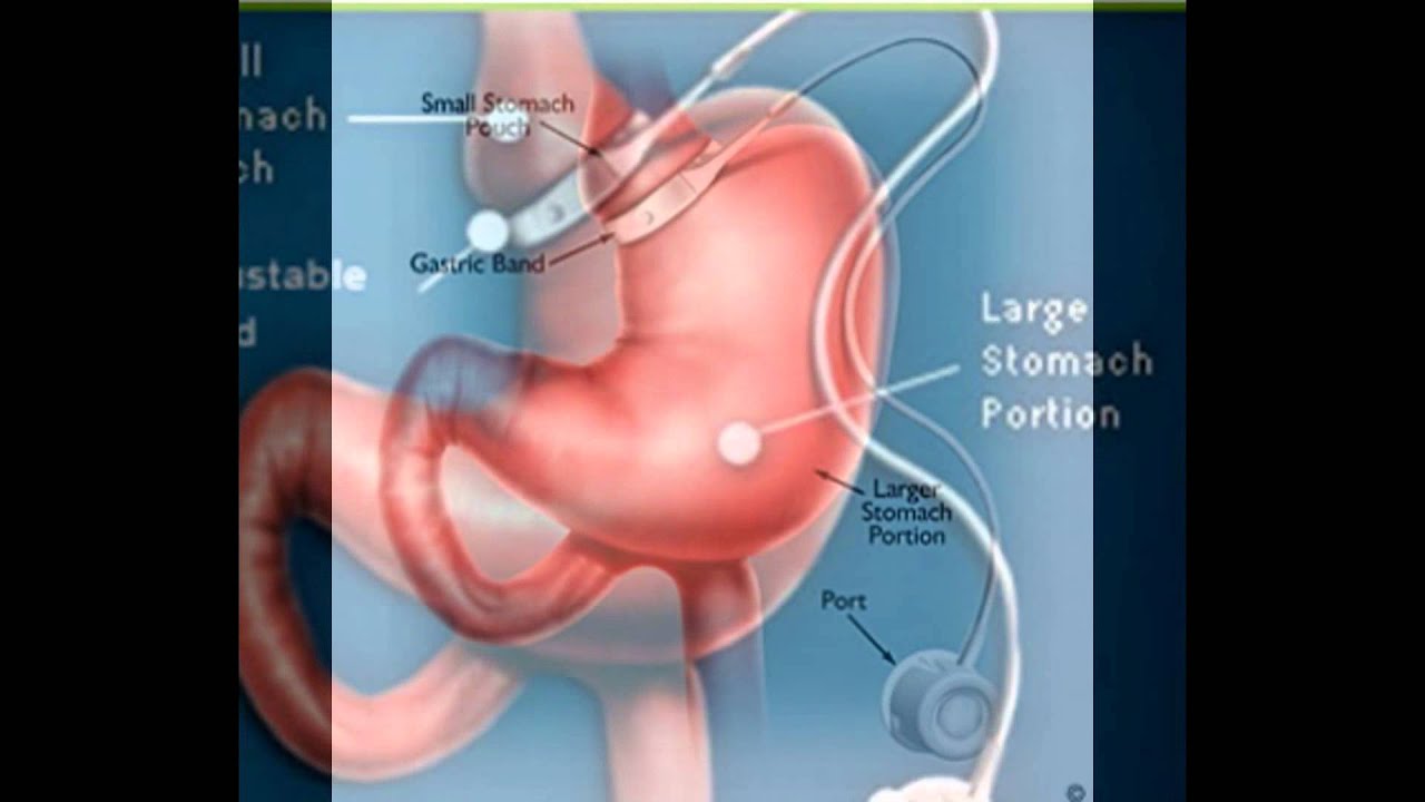 Gastric Lap Band Surgery YouTube