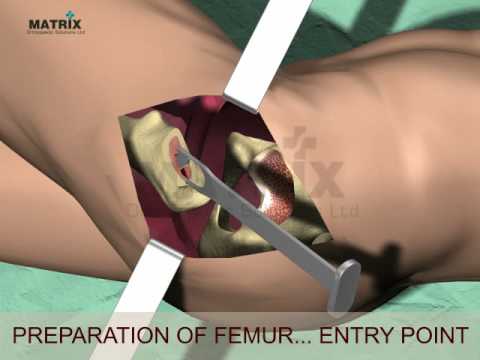 Total Hip Replacement